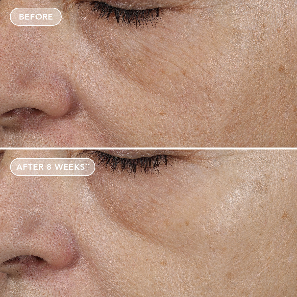 Before and after comparison of skin texture on a person's face, showing improvement over 8 weeks.
