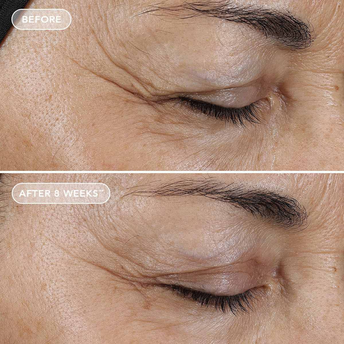 Before and after comparison of eye area skin texture with visible improvement after 8 weeks.