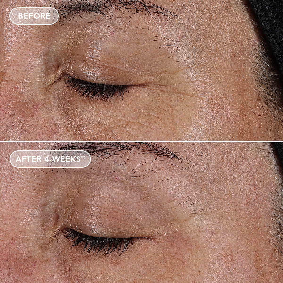 Before and after comparison of eye area skin texture with visible improvement after 4 weeks.