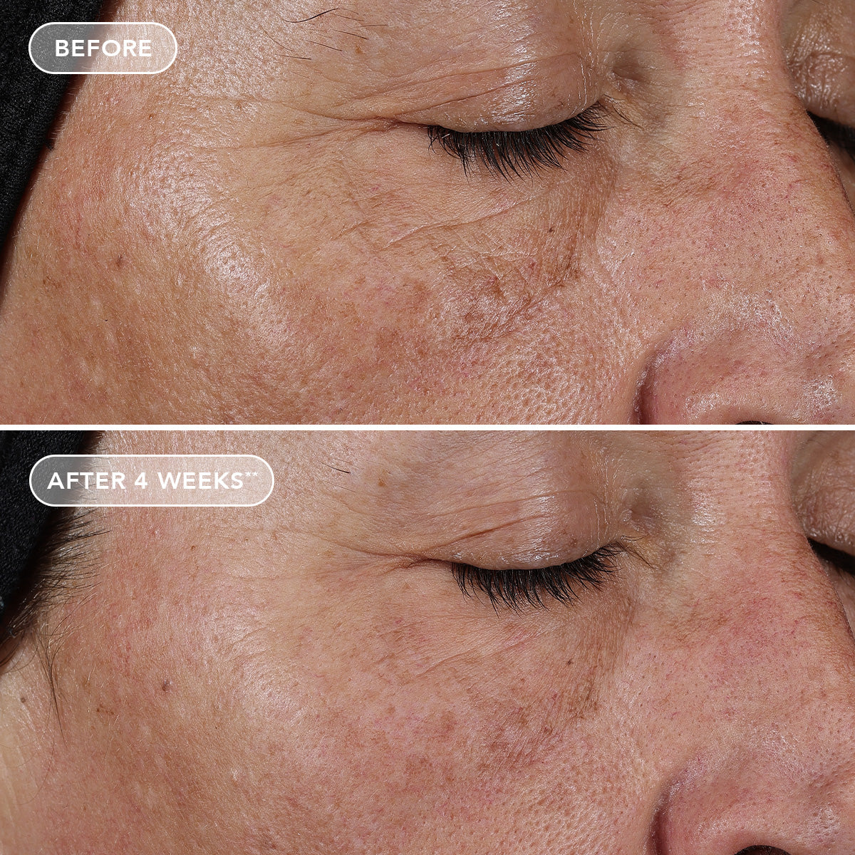 Before and after comparison of skin texture on a person's face, showing improvement after 4 weeks.