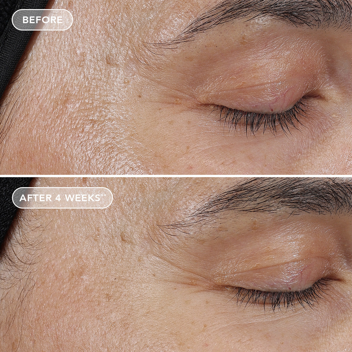 Before and after comparison of eye area skin texture on a person's face.