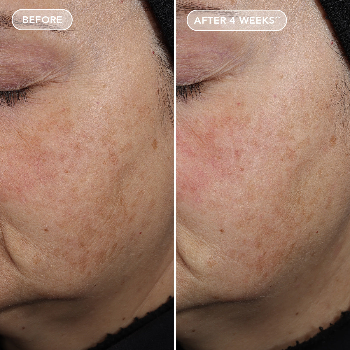 Before and after comparison of skin treatment on a person's face, showing improvement over 4 weeks.