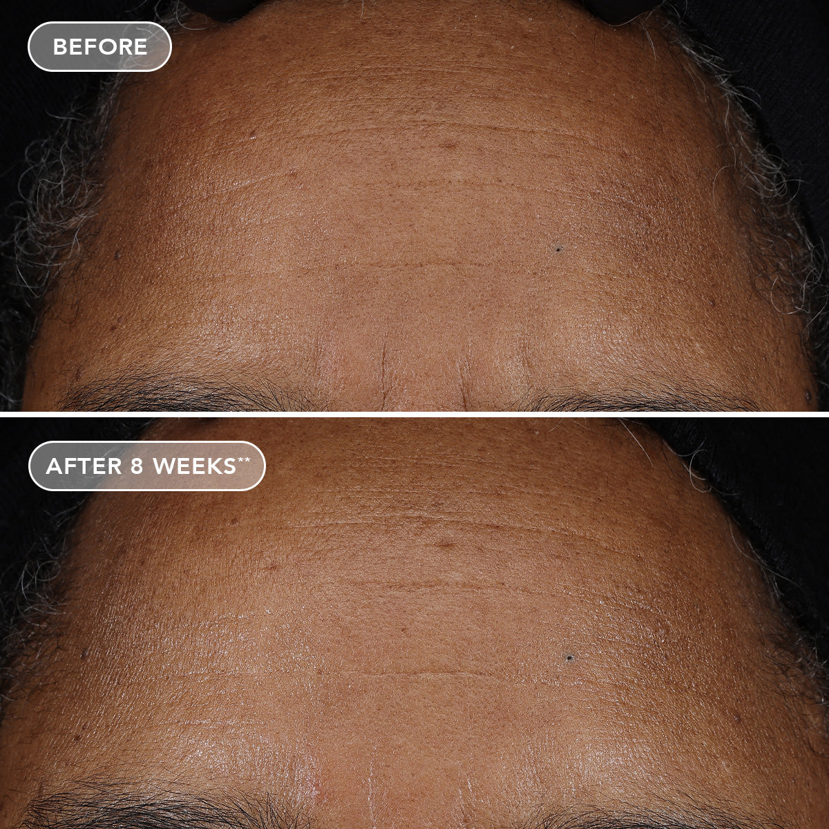 Before and after comparison of a person's skin on the forehead with text indicating 'After 8 Weeks'.
