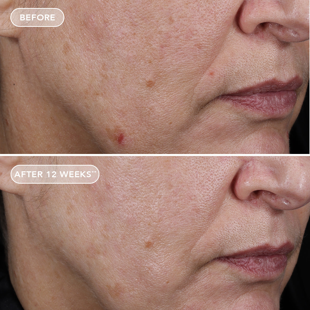 Before and after comparison of a person's skin with visible improvements after 12 weeks.