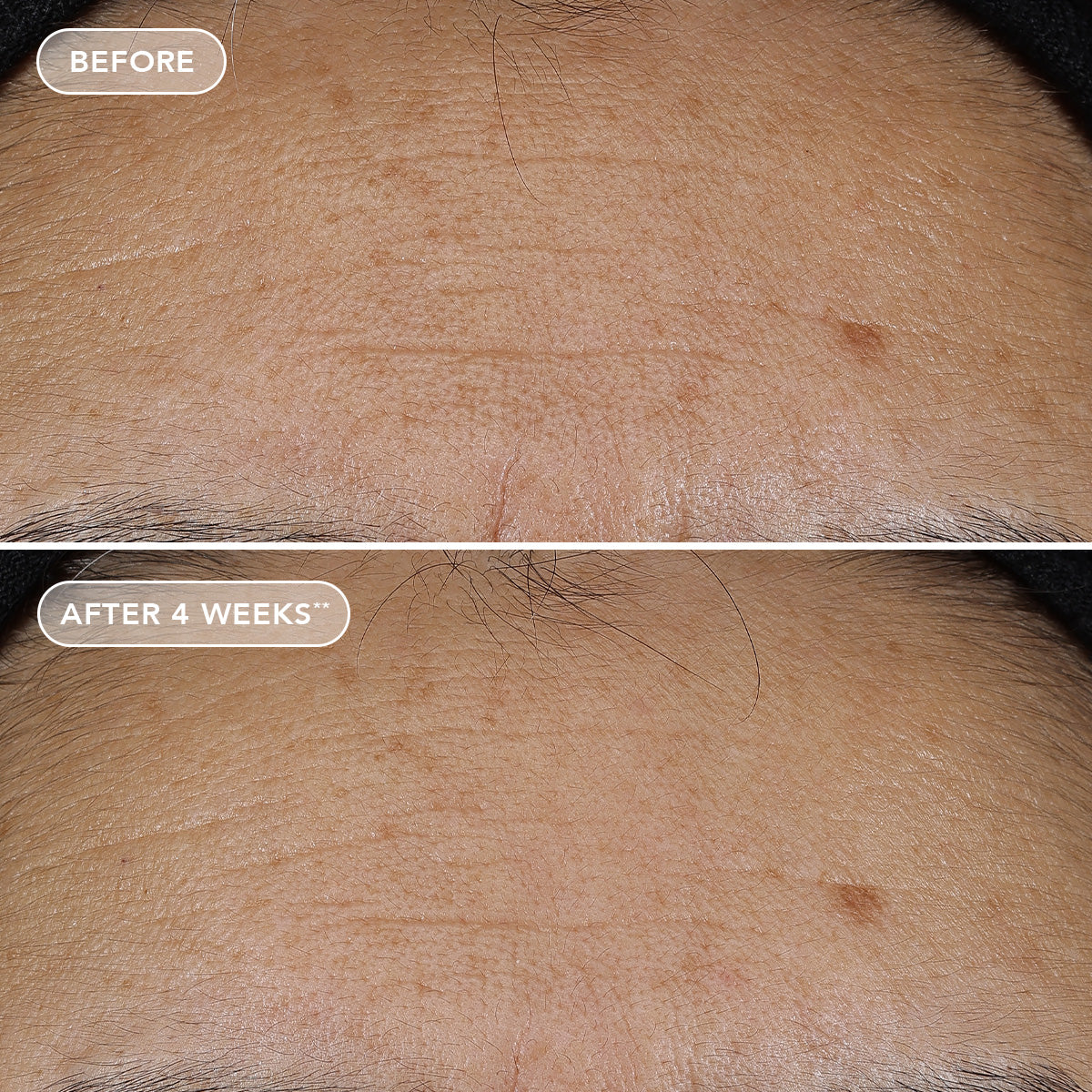 Before and after comparison of skin texture on a person's back, showing improvement after 4 weeks.