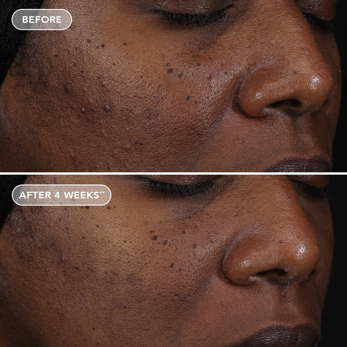 Before and after comparison of a person's skin with visible improvement after 4 weeks.