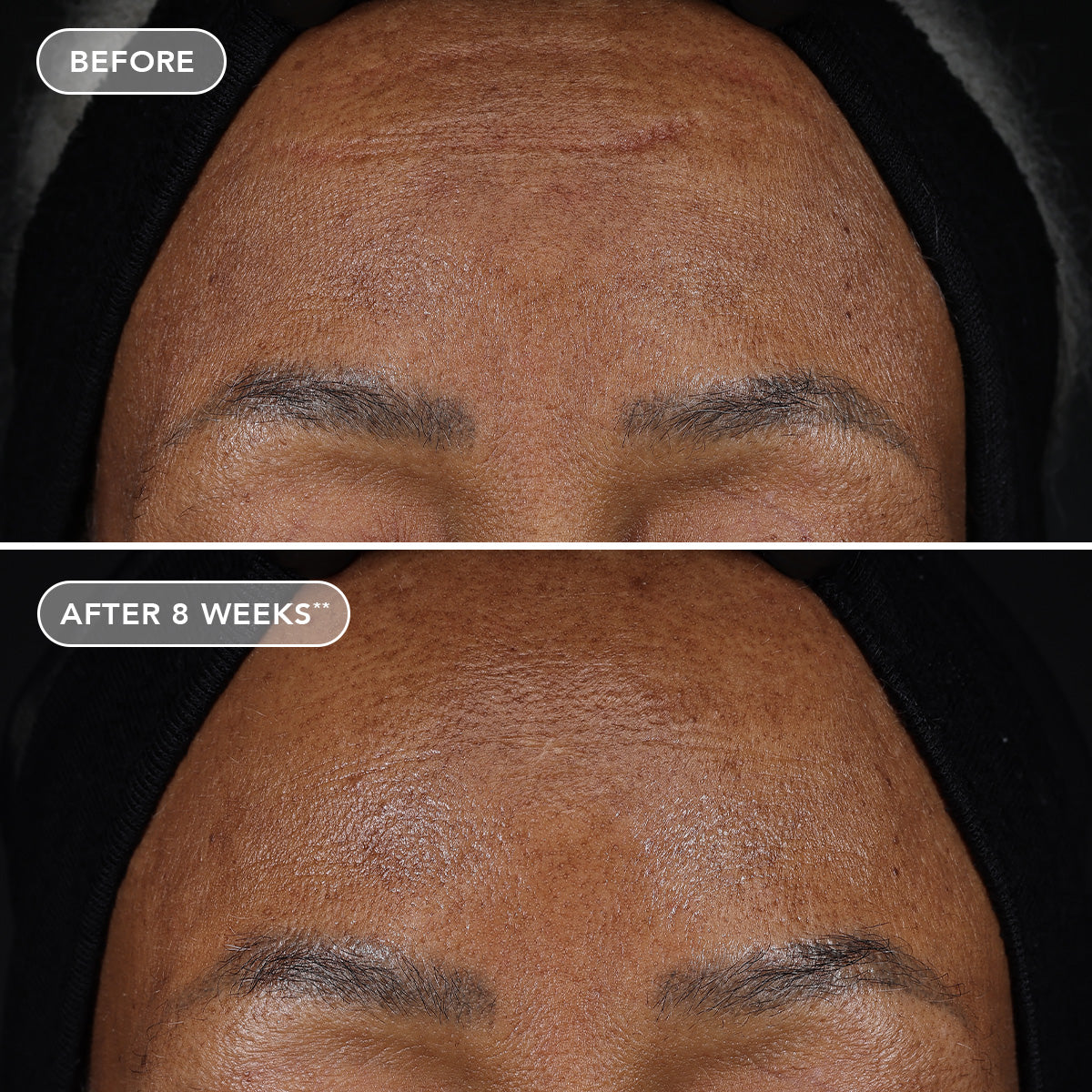 Before and after comparison of skin texture on a person's forehead with text indicating 'AFTER 8 WEEKS'.