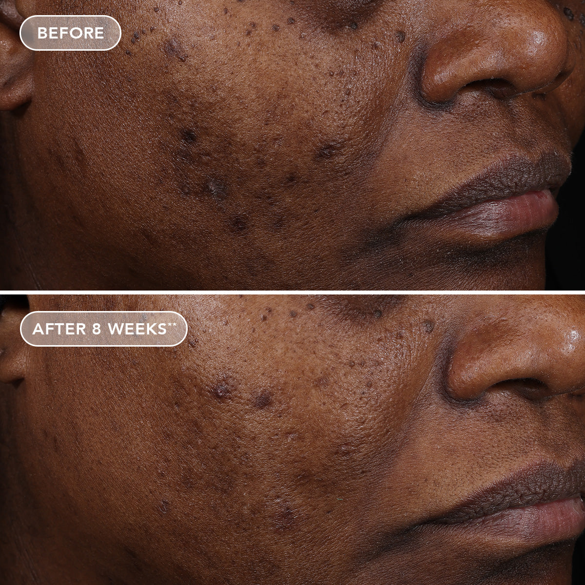 Before and after comparison of a person's face with visible skin improvement over 8 weeks.