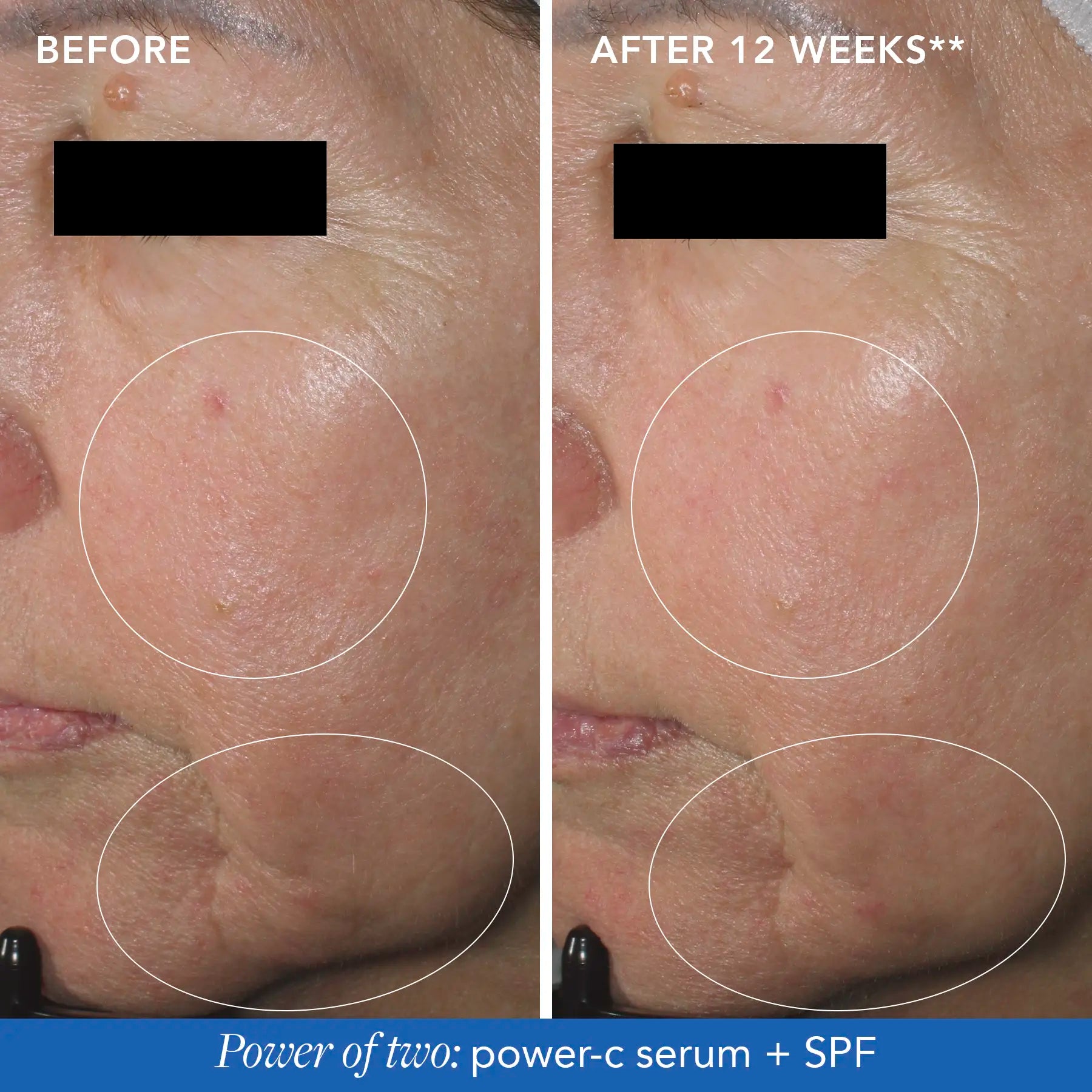 before & after 12 week results circled on a womans face