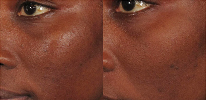 ILUMA intense facial illuminator