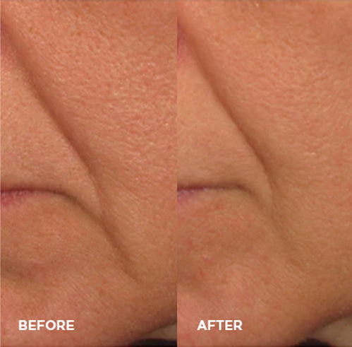 fine line and wrinkles