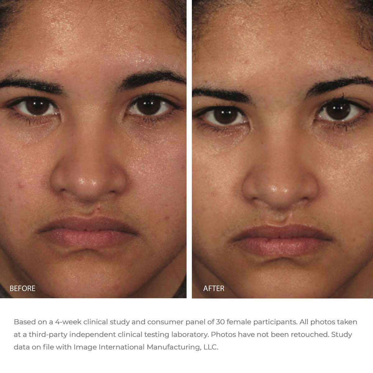 Before and after image of model face showing results after 4 weeks