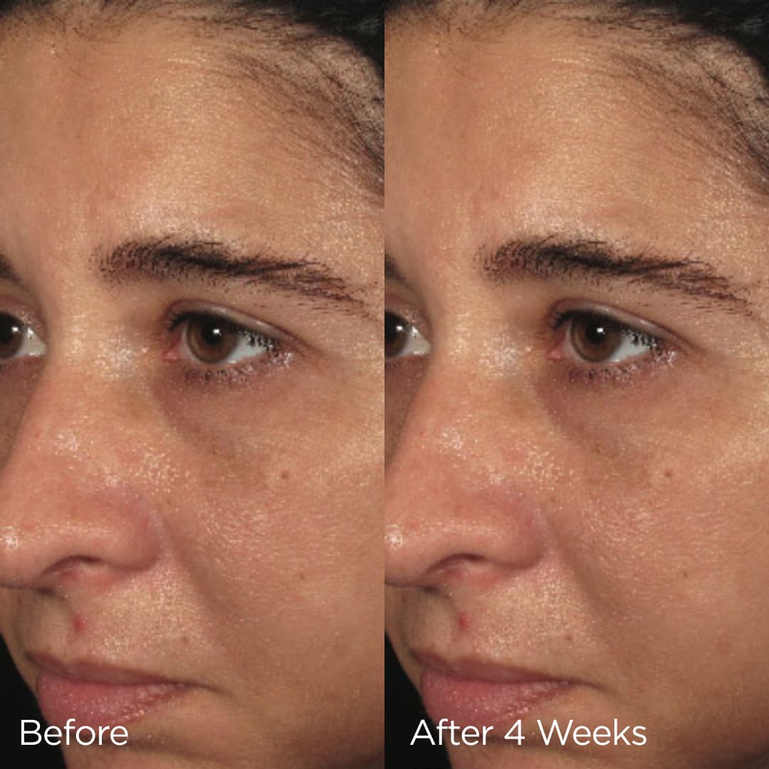 Before and after image of model showing results after 4 weeks