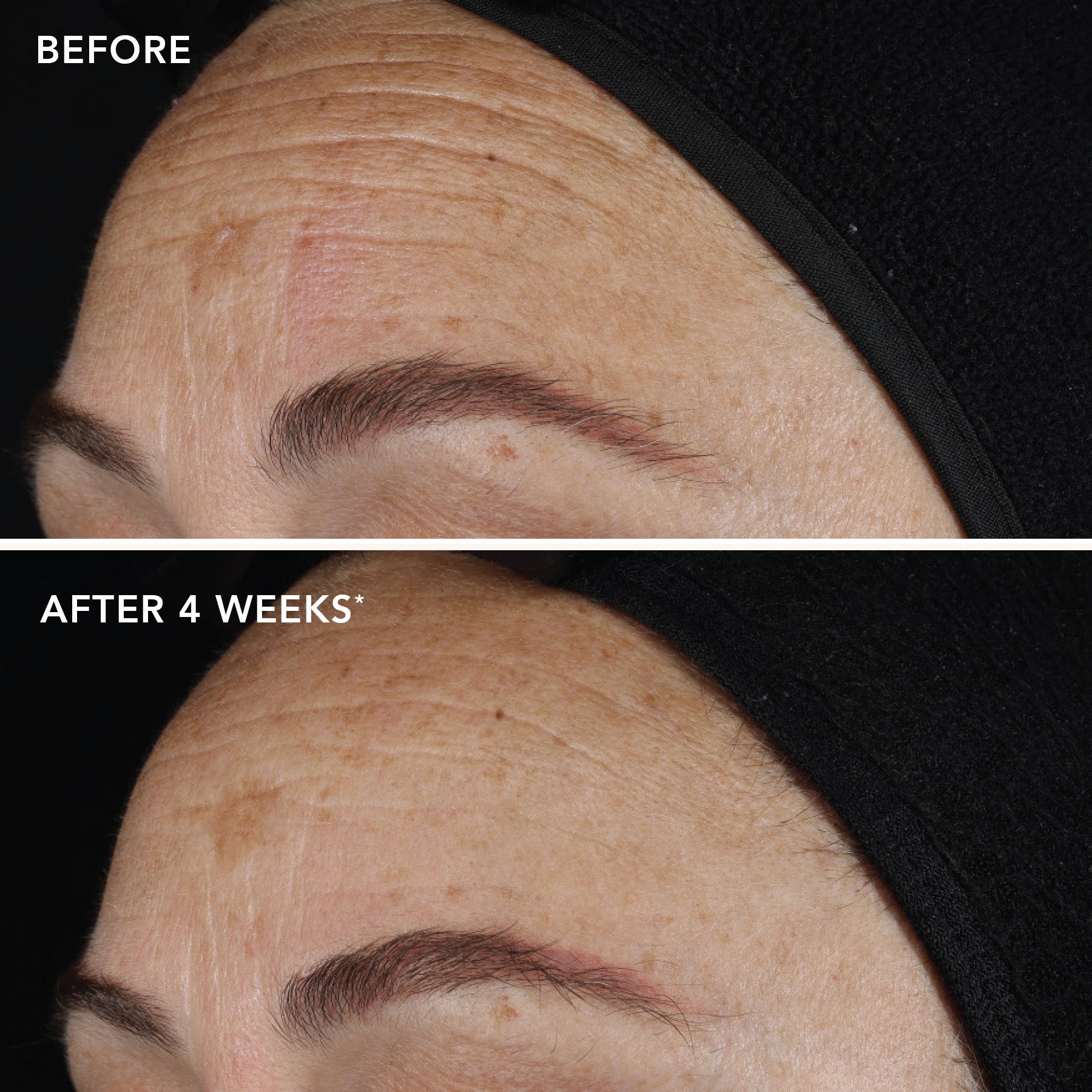 Before and after 4 week application closeup on model forehead