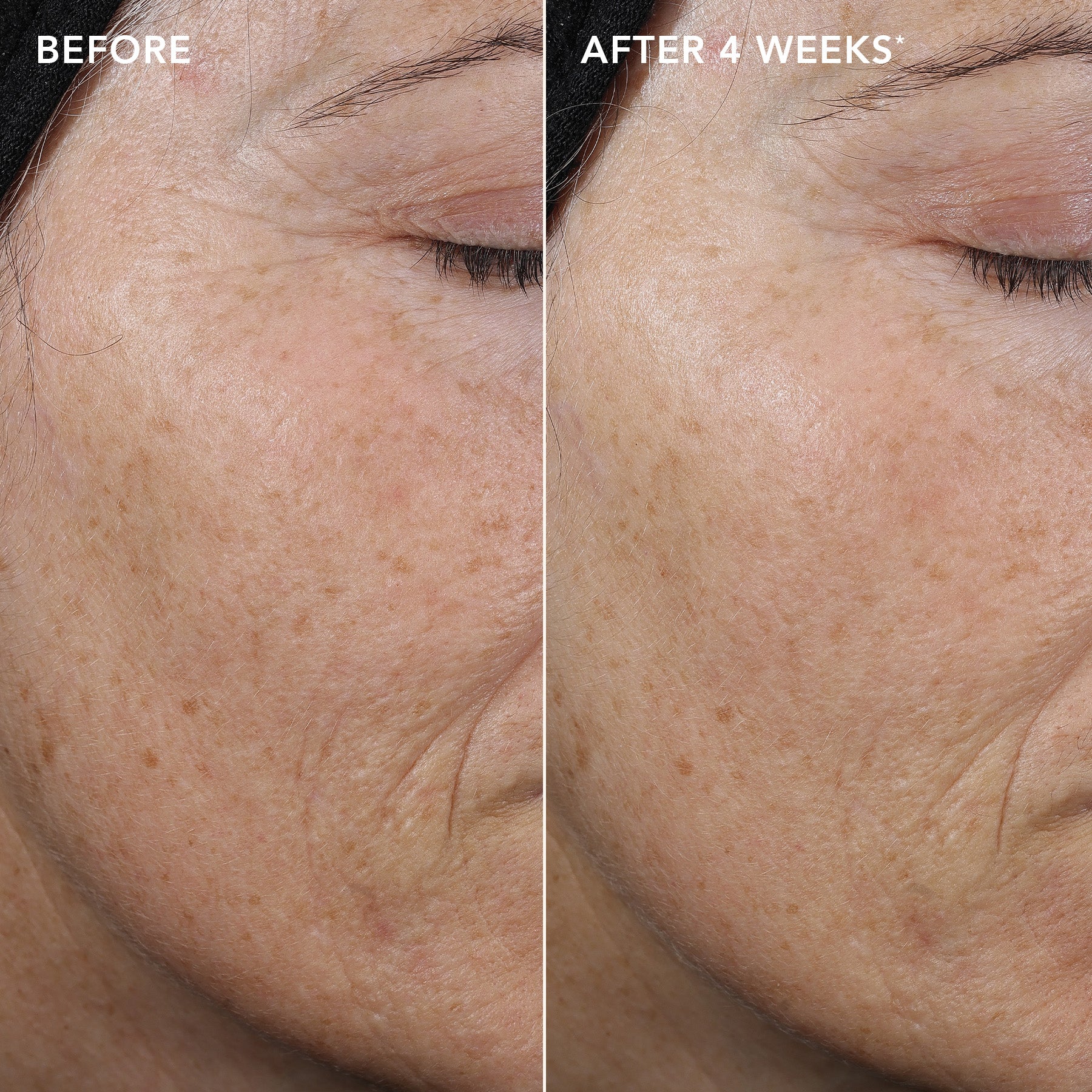 Before and after comparison of skin texture on a person's face, showing improvement after 4 weeks.