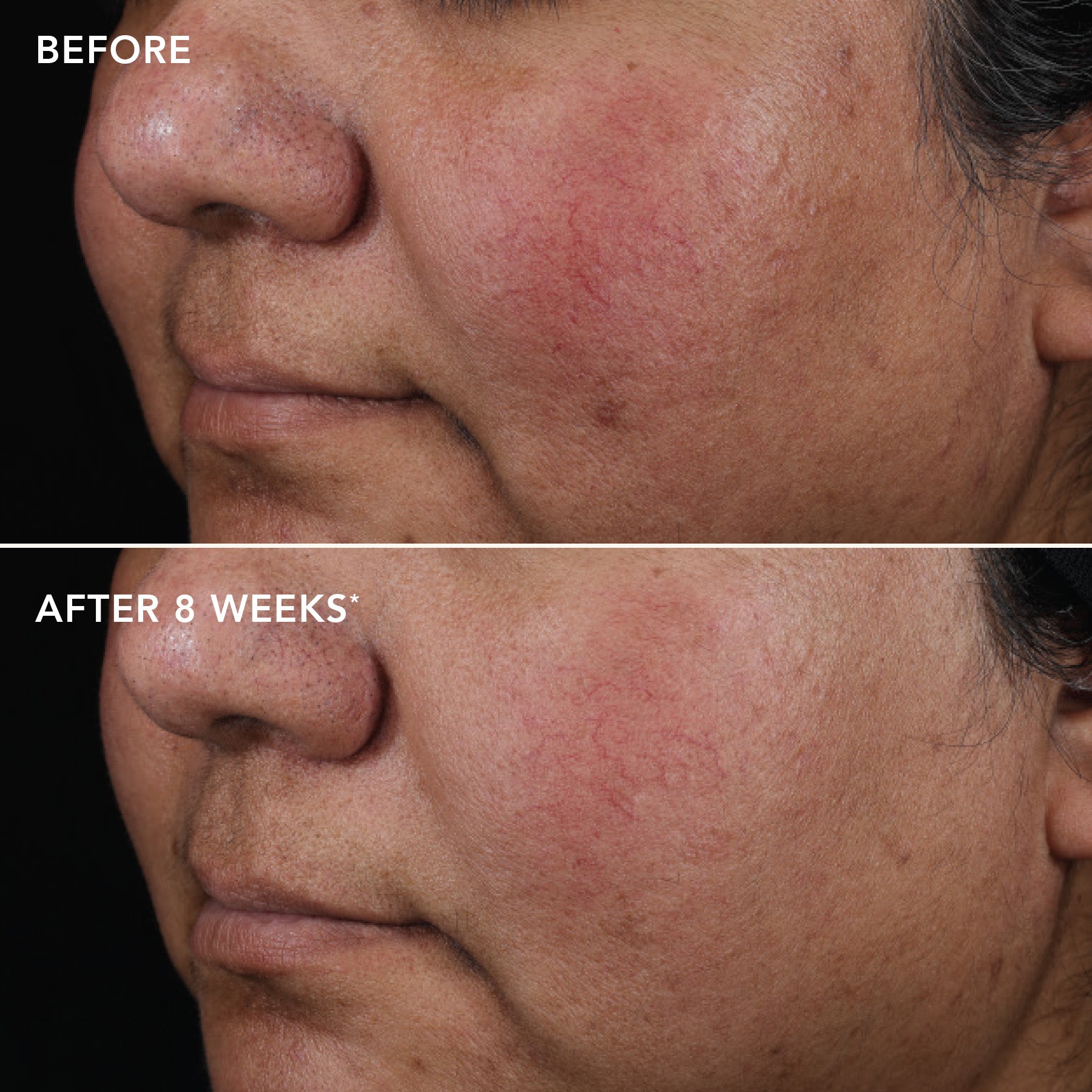 Before and after comparison of skin texture on a person's face, showing improvement after 8 weeks.
