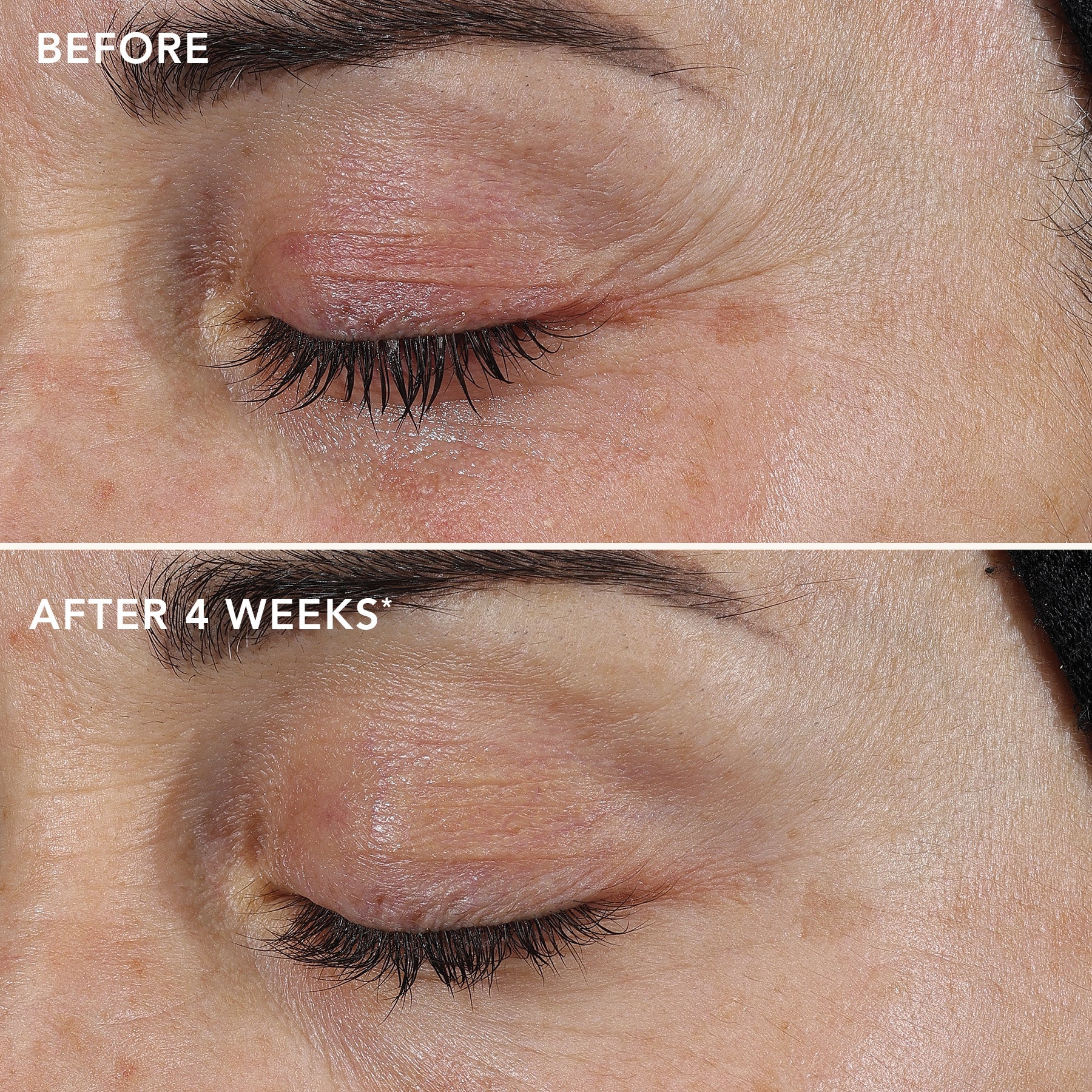 Before and after comparison of skin texture on a person's face, showing improvement over 4 weeks.