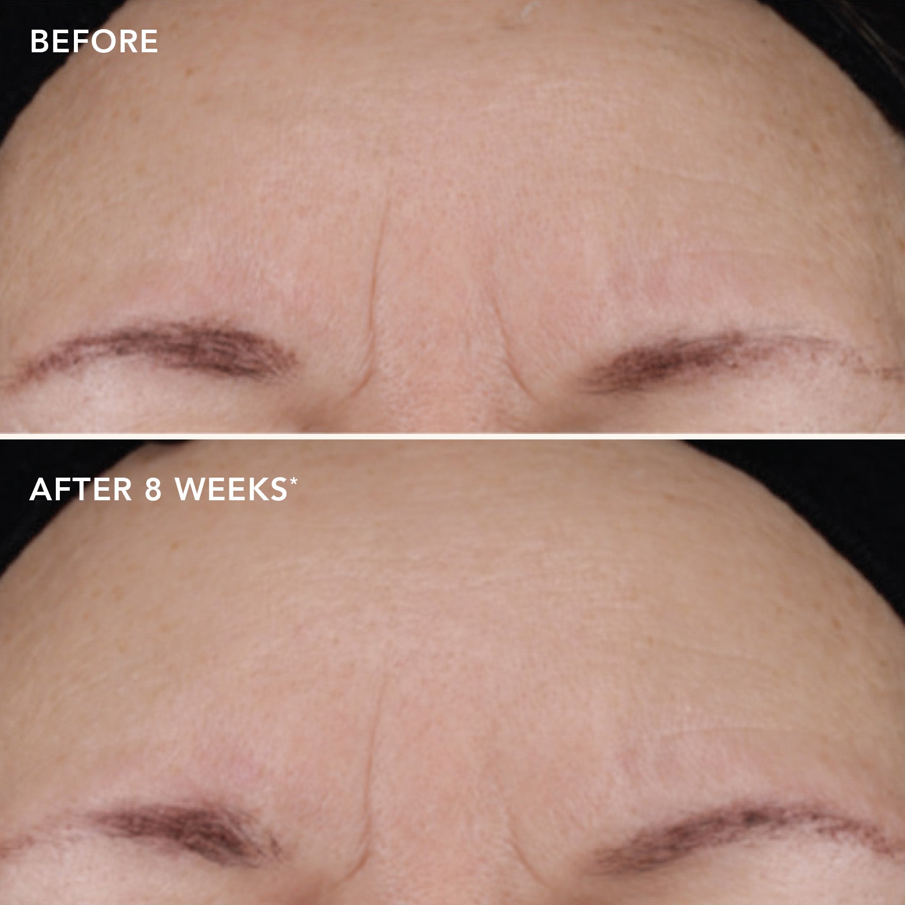 Before and after comparison of skin texture on a person's face, showing improvement over 8 weeks.