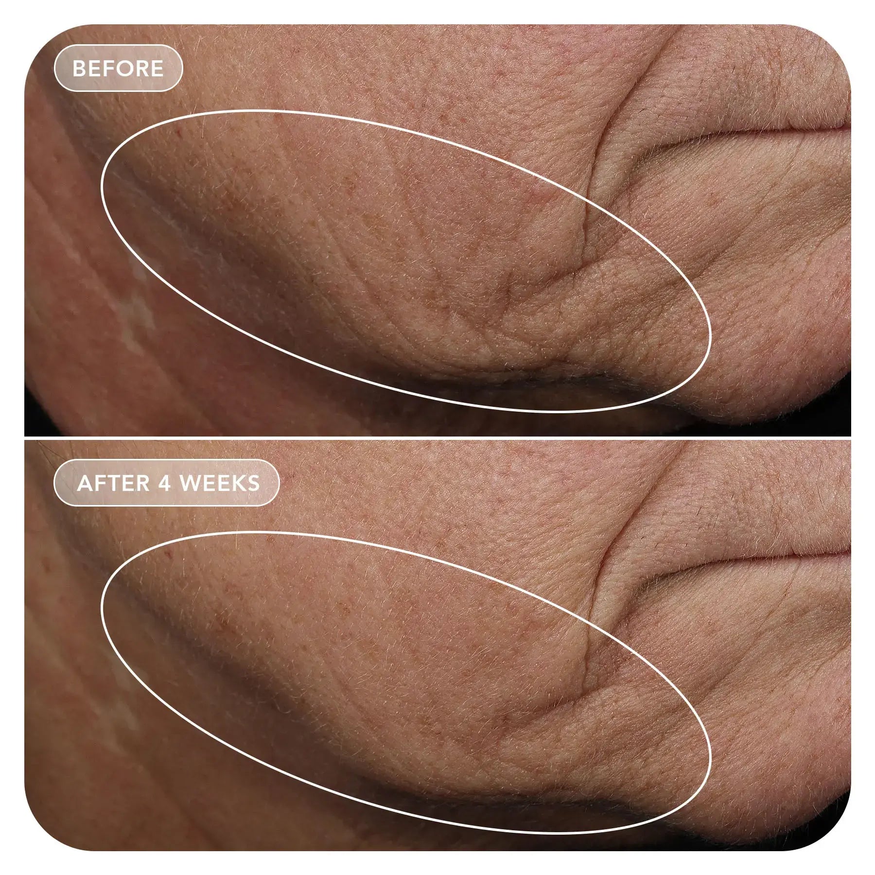 Before and after comparison of skin texture on a person's neck.