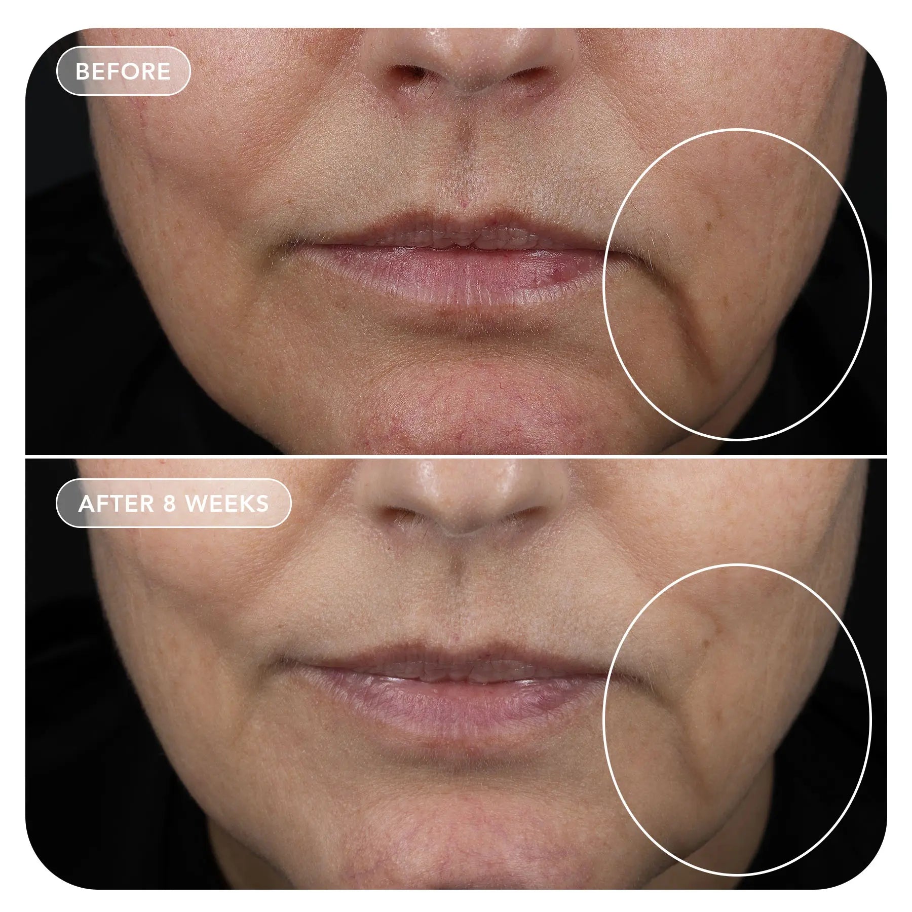 Before and after comparison of a woman's face with visible skin texture improvement over 8 weeks.