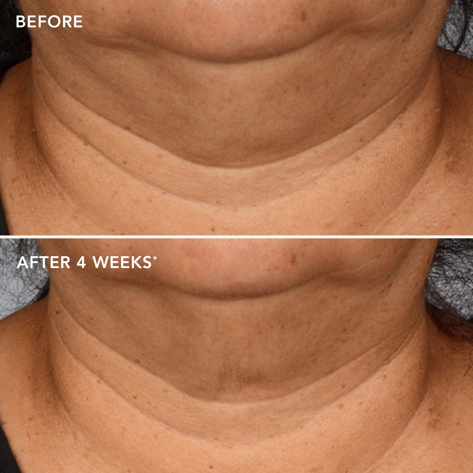 Before and after results for Max Neck Cream. 